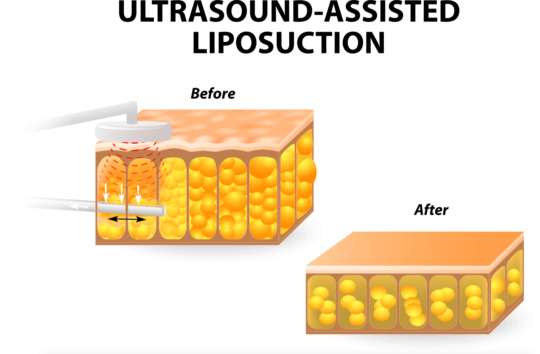 Vaser Lipo UltrasoundAssisted Liposuction Explained Fat Procedures